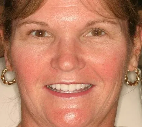 Margie's smile after treatment at The Smile Center.