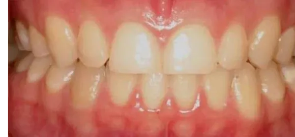 Invisalign's smile after treatment at The Smile Center.