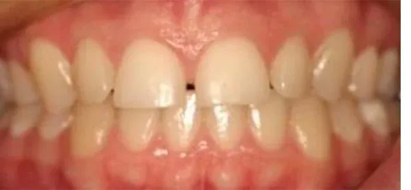 Invisalign's smile before treatment at The Smile Center.