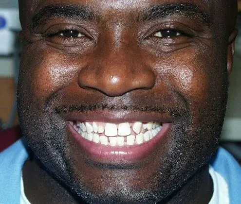Rodney's smile before treatment at The Smile Center.