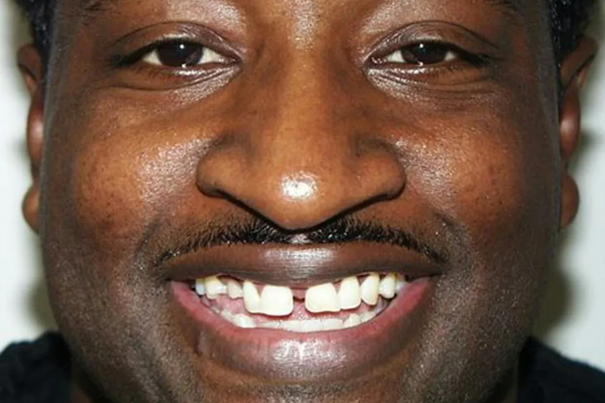 Steve, before treatment at The Smile Center.