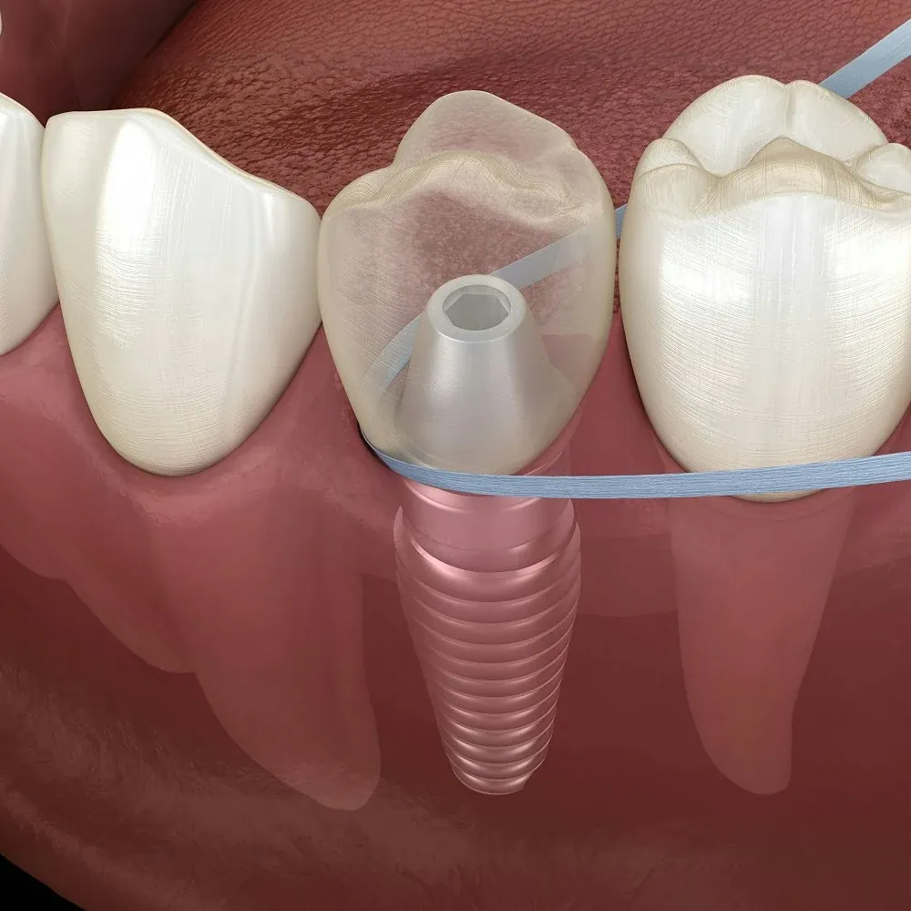 Same-Day Crowns at The Smile Center in Virginia Beach.
