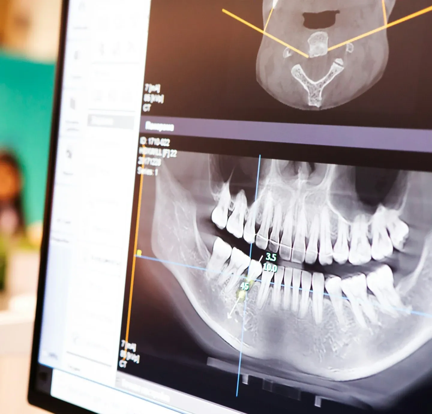 A three-dimensional CT reconstruction on the operatory screen.